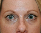 Feel Beautiful - Filler beneath lower eyelids - Before Photo
